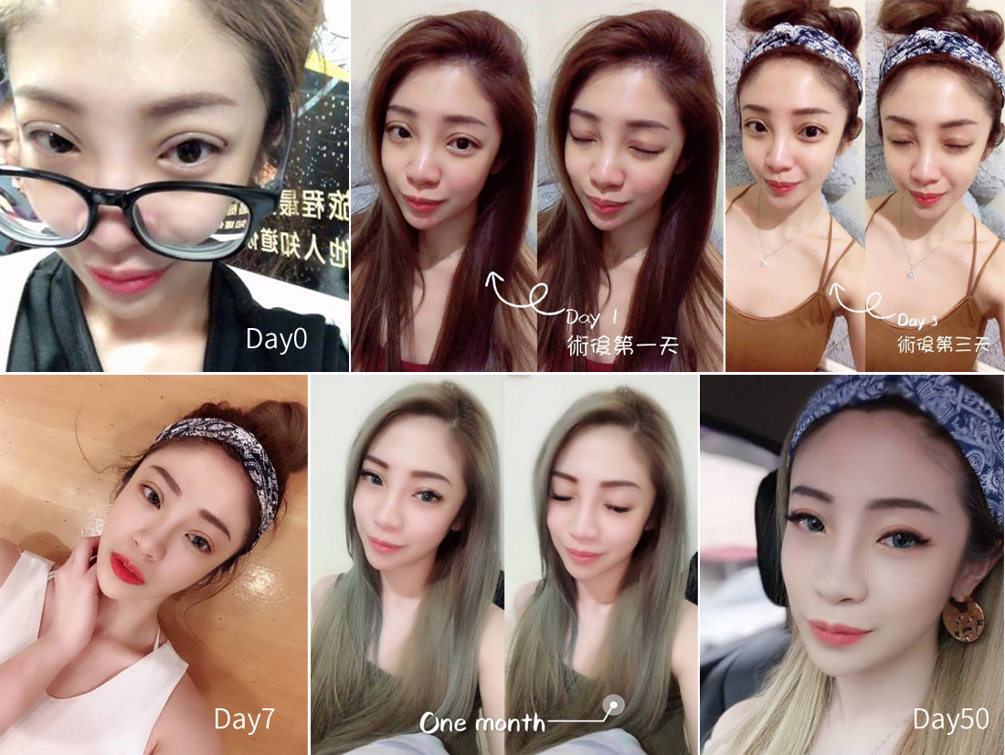 綁辮式雙眼皮