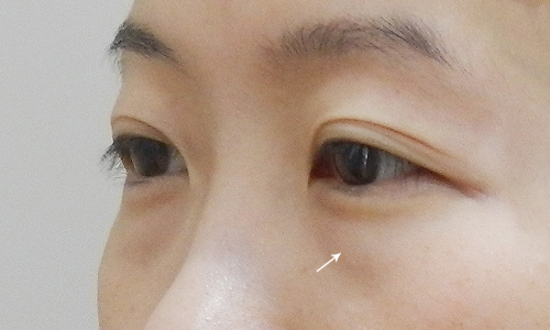 解構式眼袋手術