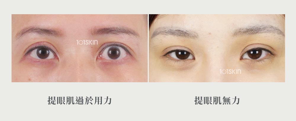 提眼肌矯正手術