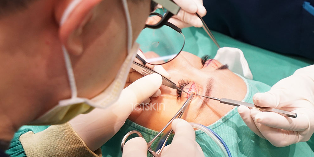 提眼肌矯正手術