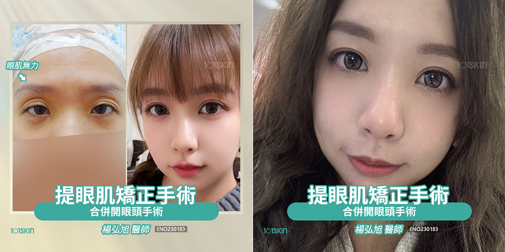 提眼肌矯正手術