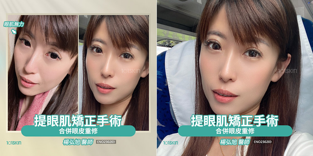 提眼肌矯正手術